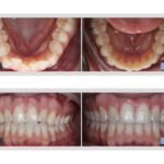 before and after invisalign