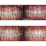 before and after invisalign