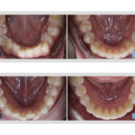 before and after invisalign