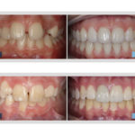 before and after invisalign