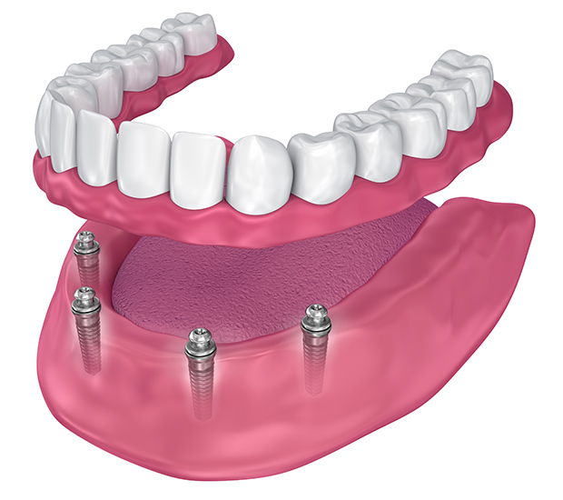 Somerville All-on-4 Implants