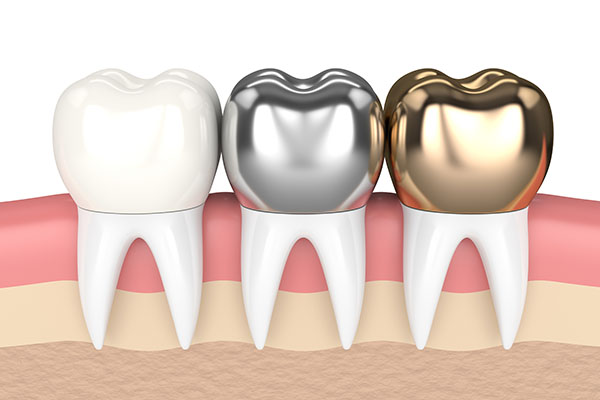 CEREC Crowns vs Traditional - Which Is Better, Bonded or Cemented in Place? from Assembly Dental in Somerville, MA