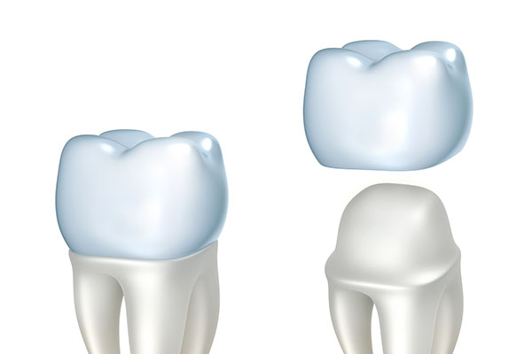Choose a CEREC Restoration for a Decayed Tooth from Assembly Dental in Somerville, MA