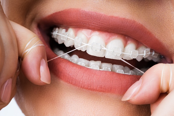 FAQs About Clear Braces Treatment