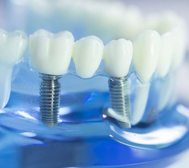 Somerville Dental Implants