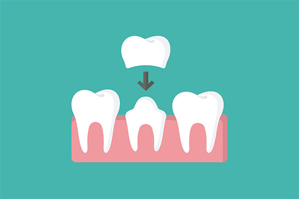 How a CEREC Crown Can  Restore a Broken Tooth from Assembly Dental in Somerville, MA