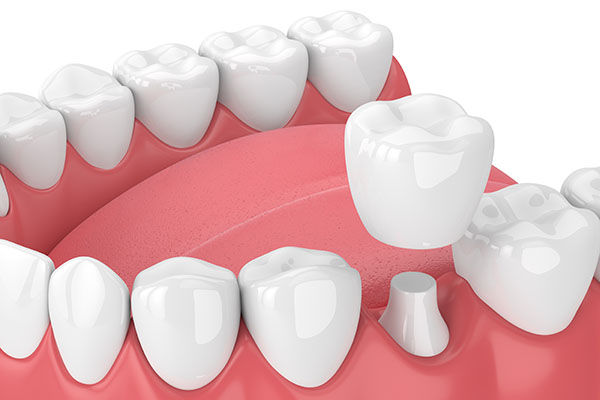 How a CEREC Restoration Can Help a Damaged Tooth from Assembly Dental in Somerville, MA