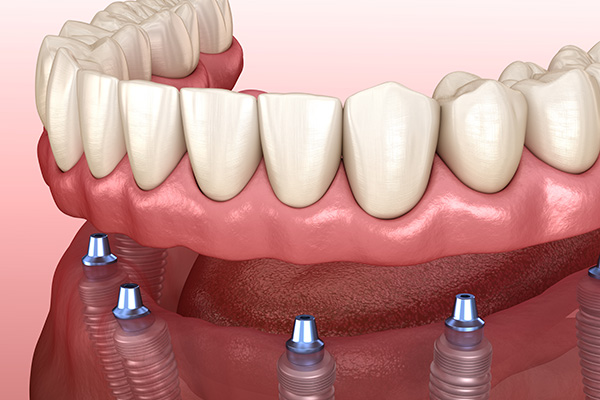 Options For Replacing Missing Teeth: Am I A Candidate For Implant Supported Dentures?
