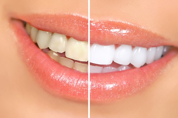 What You Need To Know About Professional Teeth Whitening Treatments